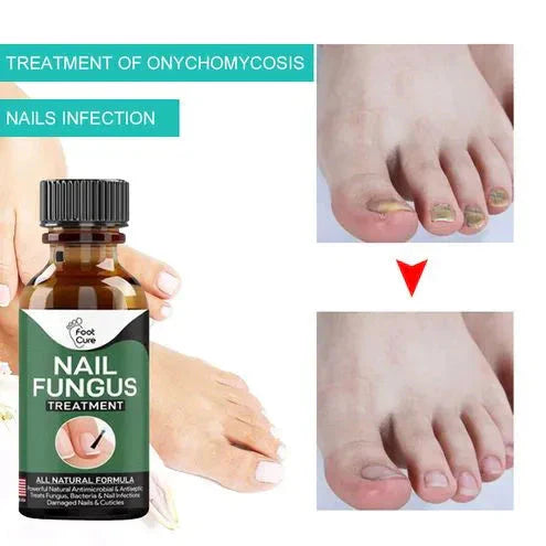 Fast Nail Fungal Treatment Serum